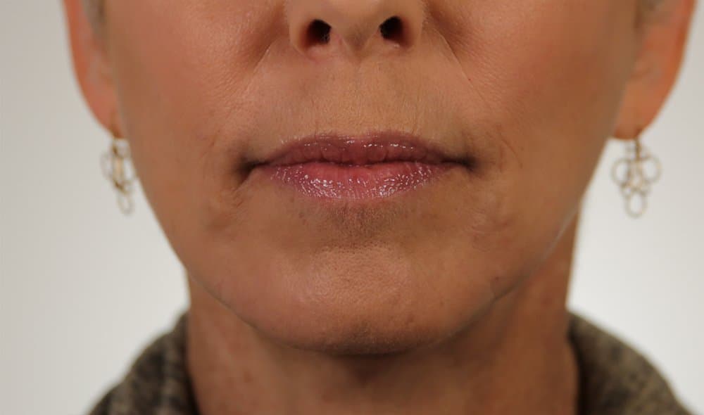 After Revanesse at Nuluk Aesthetics