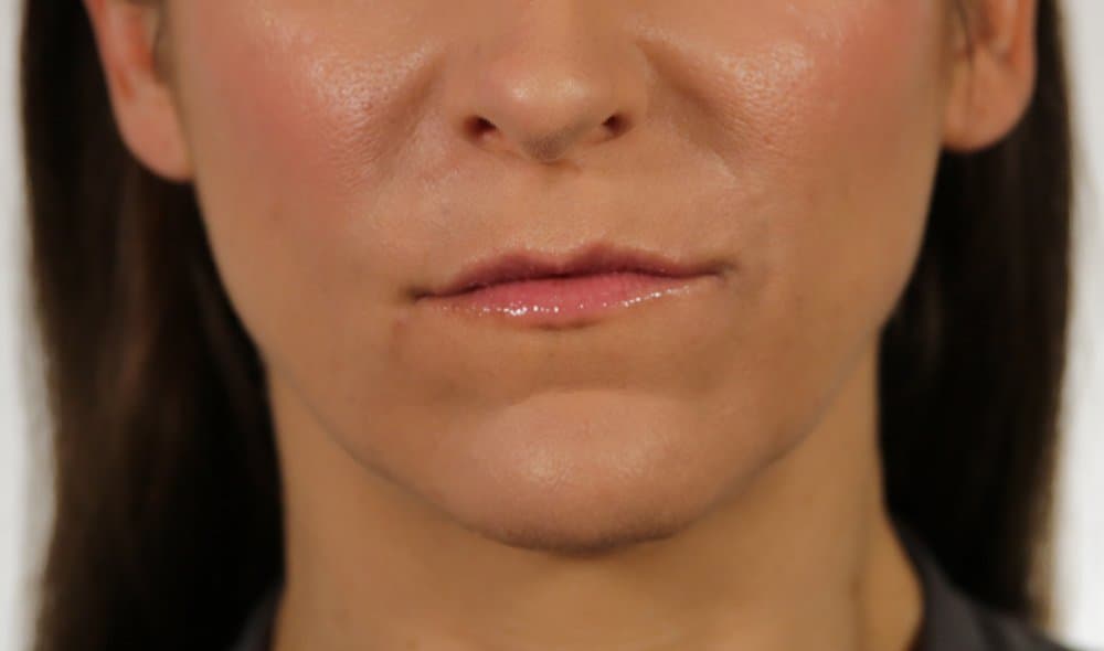 After Revanesse at Nuluk Aesthetics