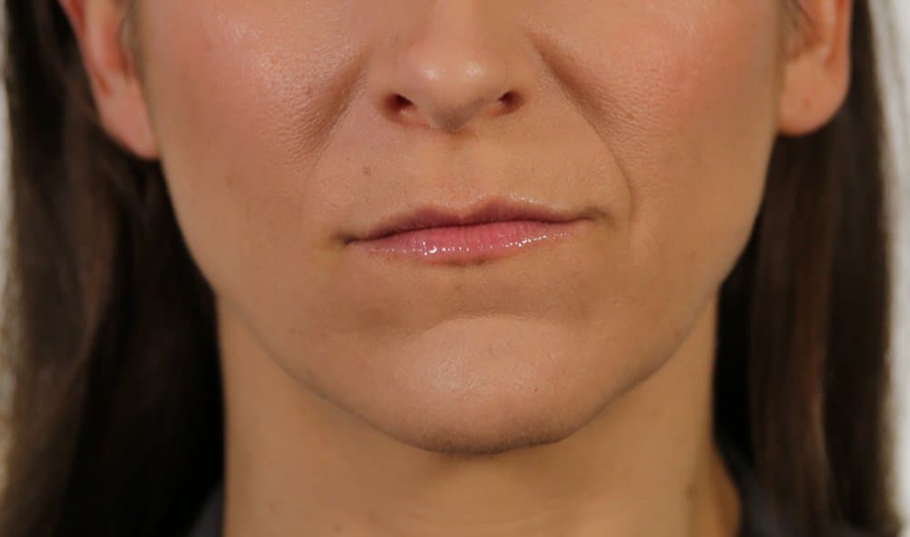 Before Revanesse at Nuluk Aesthetics