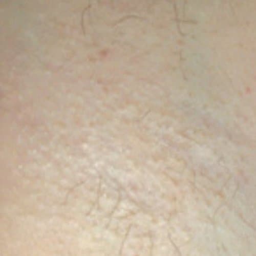 After Laser Hair Removal at Nuluk Aesthetics