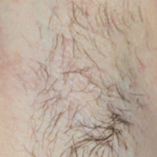 Before Laser Hair Removal at Nuluk Aesthetics