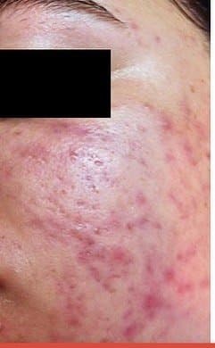 Before Microneedling at Nuluk Aesthetics