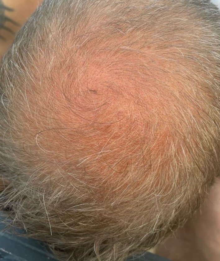 Before PRP Hair Loss Treatment