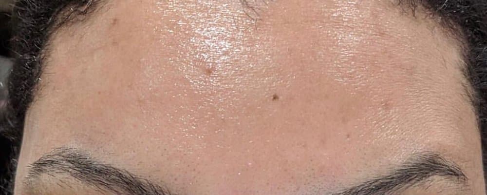 Injectables