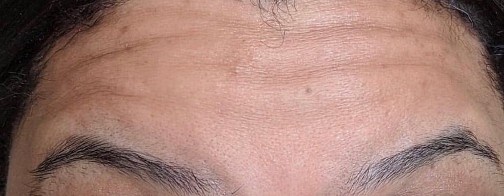Before Xeomin at Nuluk Aesthetics