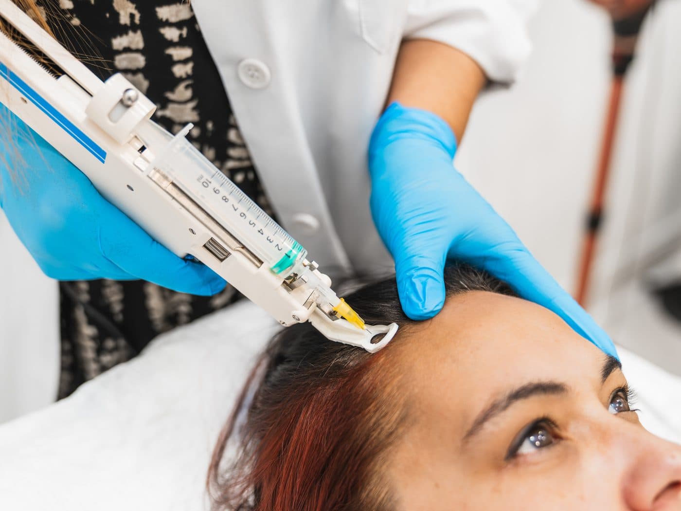PRP Hair Loss Treatment